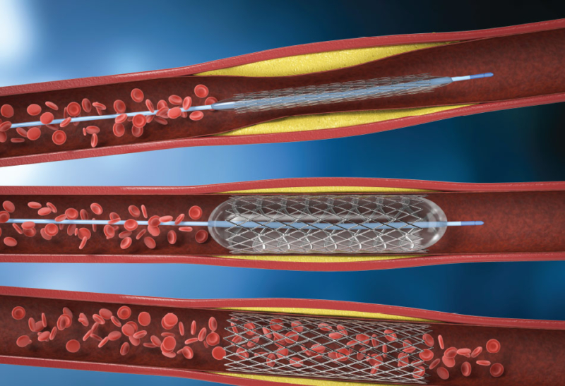 angioplastyguidewires Strand Products